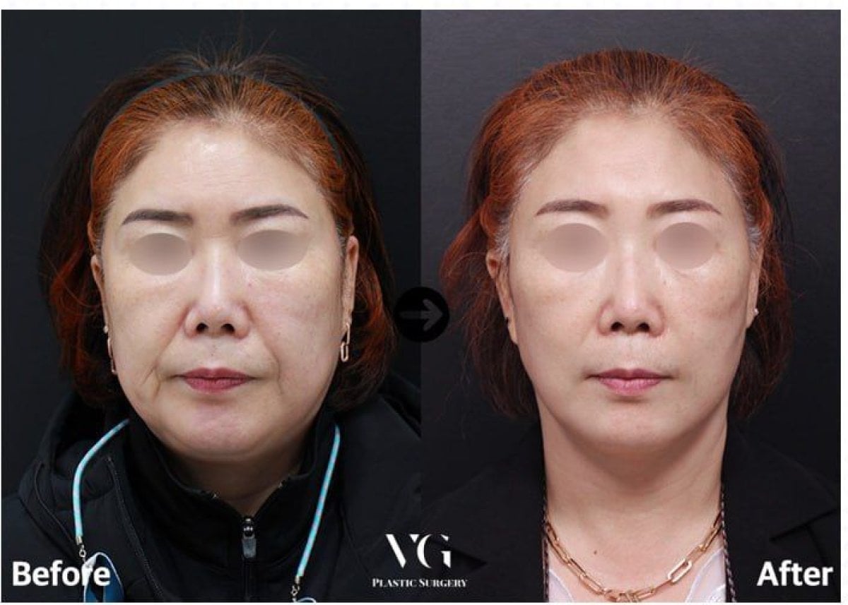 نتيجة شد الوجه غير الجراحي قبل وبعد في VG Plastic Surgery – تجديد شباب الوجه ملحوظ