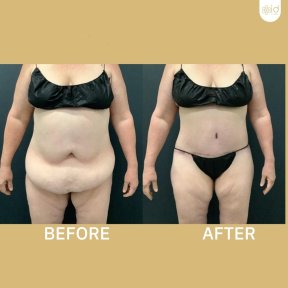 Before and after tummy tuck results at ID Clinic Bangkok, visible abdominal contour improvement