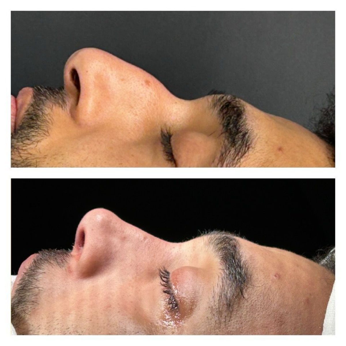 Resultados antes y después de rinoplastia abierta en Memorial Şişli Hospital, perfil nasal mejorado