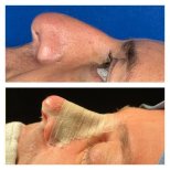 Before and after open rhinoplasty results at Memorial Şişli Hospital, improved nose profile