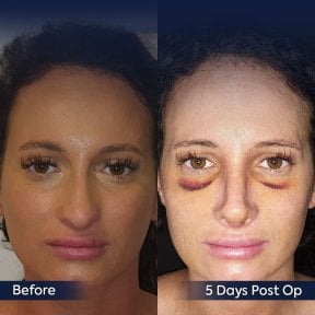 Vorher-nachher-Rhinoplastik bei Dr. Safa Manav Clinic, Ergebnis 5 Tage nach OP