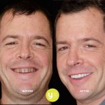 Before and after All-on-4 Dental Implants photos by Dr.
