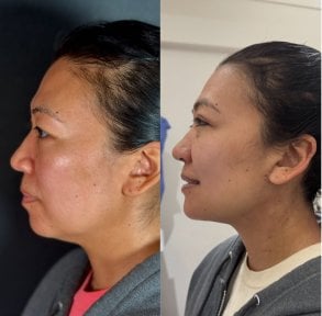 Before and after neck lift results at Marroquín & Sandoval Plastic Surgery Clinic, improved contour