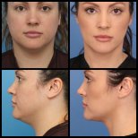 Результаты липосакции подбородка до и после в клинике Dr. Alexandro Aguilera - Plastic Surgery