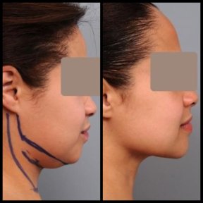 Результаты липосакции подбородка до и после в клинике Dr. Alexandro Aguilera - Plastic Surgery