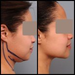 Результаты липосакции подбородка до и после в клинике Dr. Alexandro Aguilera - Plastic Surgery