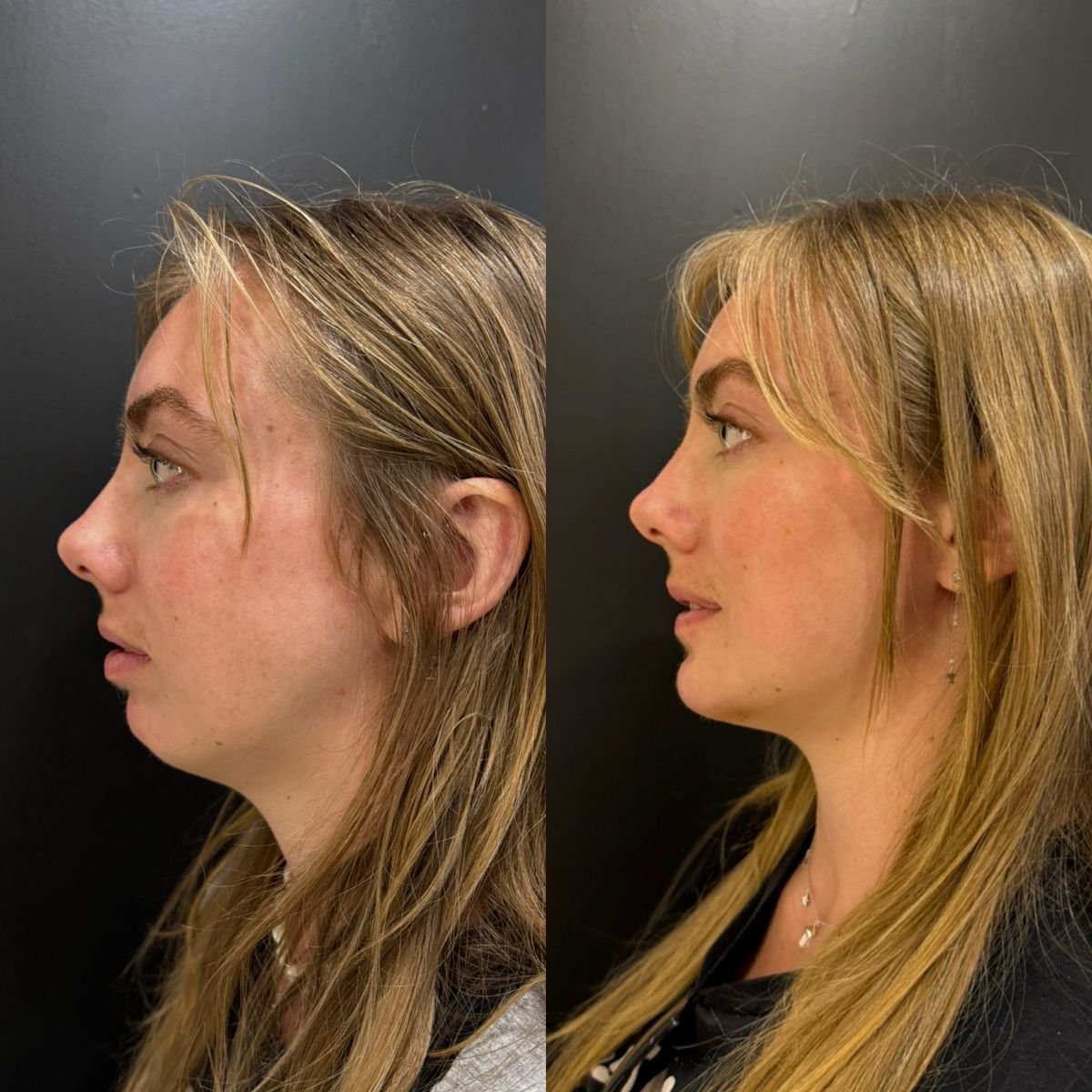 Before and after chin liposuction results at Dr. Alexandro Aguilera - Plastic Surgery clinic