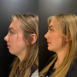 Результаты липосакции подбородка до и после в клинике Dr. Alexandro Aguilera - Plastic Surgery