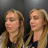 Результаты липосакции подбородка до и после в клинике Dr. Alexandro Aguilera - Plastic Surgery