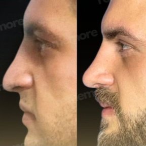 Before and after open rhinoplasty results at Memorial Şişli Hospital, improved nose profile