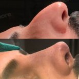 Before and after open rhinoplasty results at Memorial Şişli Hospital, improved nose profile