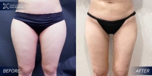 Before and after thigh lift results at Asia Cosmetic Hospital, improved thigh contour visible