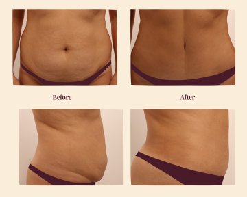 Vorher-nachher-Ergebnis Bauchdeckenstraffung und Fettabsaugung bei InSense Clinic, flacher Bauch