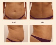 Vorher-nachher-Ergebnis Bauchdeckenstraffung und Fettabsaugung bei InSense Clinic, flacher Bauch