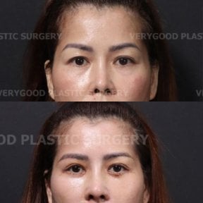 Результаты блефаропластики нижних век до и после в VG Plastic Surgery, омоложение глаз
