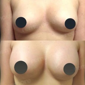 Before and after mammoplasty results at Memorial Ataşehir Hospital, breast augmentation outcome