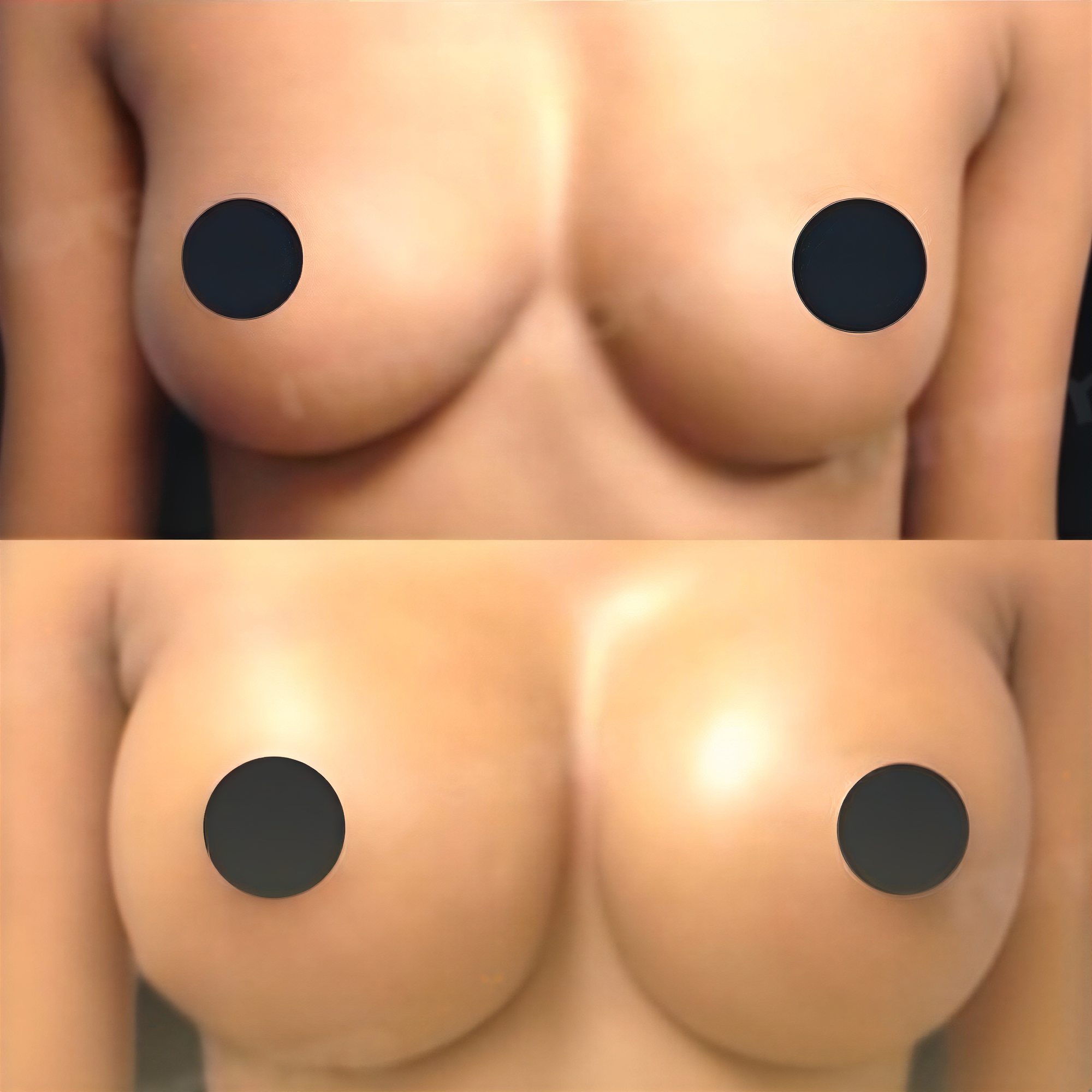 Resultados de mamoplastia antes y después en Memorial Ataşehir Hospital, forma mejorada