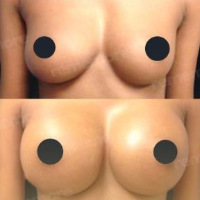 Before and after mammoplasty results at Memorial Ataşehir Hospital, enhanced breast shape