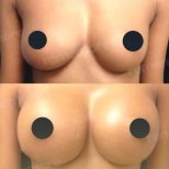 Before and after mammoplasty results at Memorial Ataşehir Hospital, enhanced breast shape