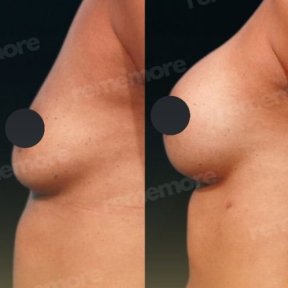 Before and after mammoplasty results at Memorial Ataşehir Hospital, visible breast enhancement