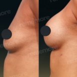 Before and after mammoplasty results at Memorial Ataşehir Hospital, visible breast enhancement