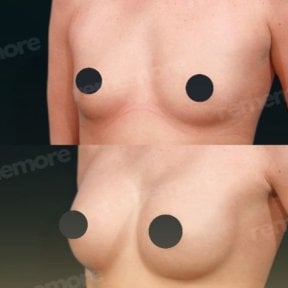 Before and after mammoplasty results at Memorial Ataşehir Hospital, visible breast enhancement