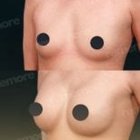 Before and after mammoplasty results at Memorial Ataşehir Hospital, visible breast enhancement