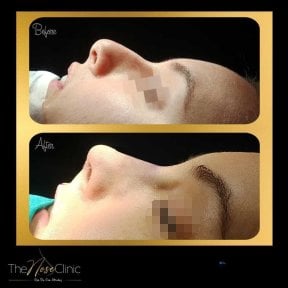 Before and after rhinoplasty results at The Nose Clinic, improved nose profile and contour