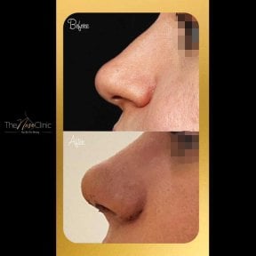 Before and after rhinoplasty results at The Nose Clinic, nose reshaping with natural outcome