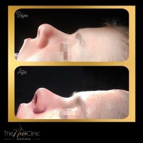 Before and after rhinoplasty results at The Nose Clinic, nose reshaping with natural profile