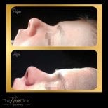 Before and after rhinoplasty results at The Nose Clinic, nose reshaping with natural profile