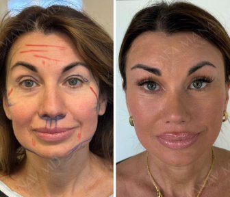 Vorher-nachher-Ergebnis des Facial Fat Transfer in der Dr. Safa Manav Klinik, Volumen sichtbar