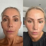 Vorher-nachher-Ergebnis der Gesichts-Fetttransfer bei Dr. Safa Manav Clinic