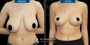 Before and after breast lift results at Dr. Safa Manav Clinic, improved breast contour