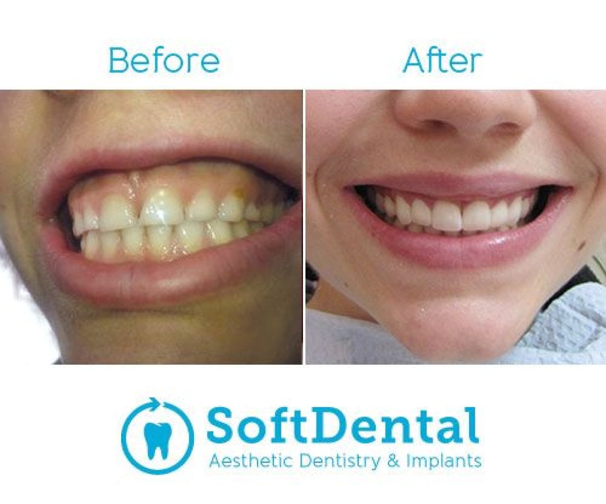 نتائج قبل وبعد جراحة اللثة في SoftDentalCare Clinic – تحسين مظهر اللثة والابتسامة