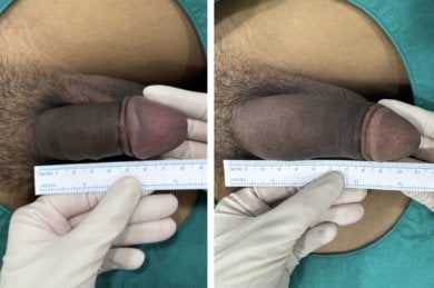 Resultados de alargamiento de pene antes y después en Eternity Clinic Pleonchit, aumento visible