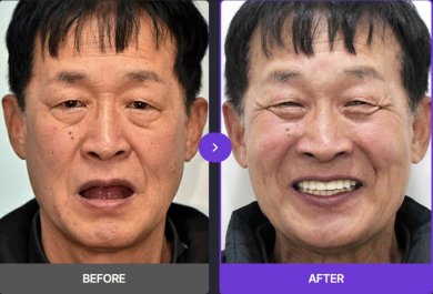 Before and after All-on-6 dental implants result at 365SeoulOneTop365 Dental Clinic, smile restored
