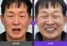 Before and after All-on-6 dental implants result at 365SeoulOneTop365 Dental Clinic, smile restored