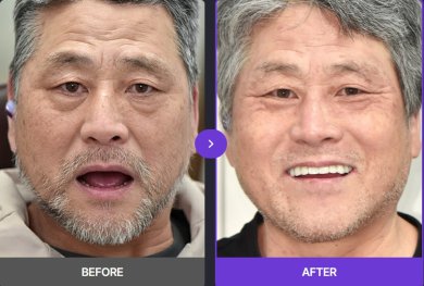 Efekt przed i po implantach All-on-4 w 365SeoulOneTop365 Dental Clinic, poprawiony uśmiech