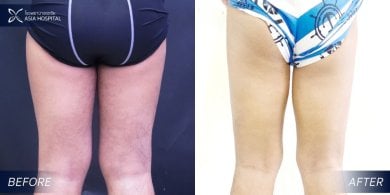 Before and after thigh lift results at Asia Cosmetic Hospital – improved thigh contour