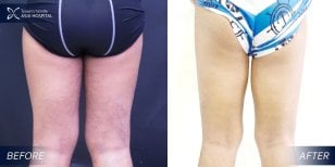 Before and after thigh lift results at Asia Cosmetic Hospital – improved thigh contour
