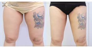 Before and after thigh lift results at Asia Cosmetic Hospital, improved thigh contour visible