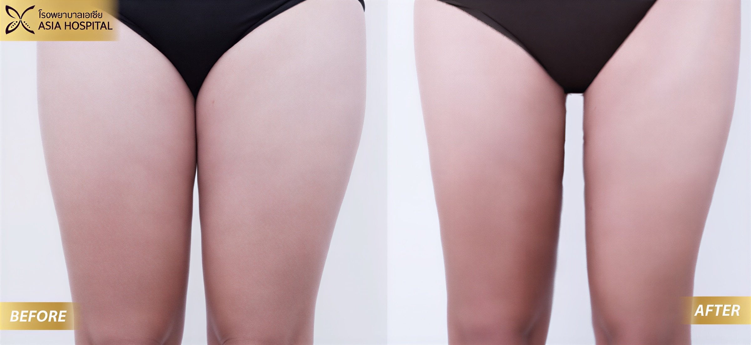 Resultados de lifting de muslos antes y después en Asia Cosmetic Hospital, contorno mejorado
