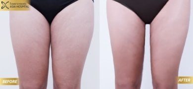 Before and after thigh lift results at Asia Cosmetic Hospital, improved thigh contour visible