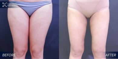 Before and after thigh lift results at Asia Cosmetic Hospital, improved thigh contour visible