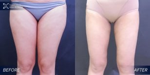 Before and after thigh lift results at Asia Cosmetic Hospital, improved thigh contour visible