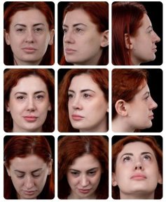 Before and after rhinoplasty results at Yurchenko Plastic Surgery Team, nose reshaping