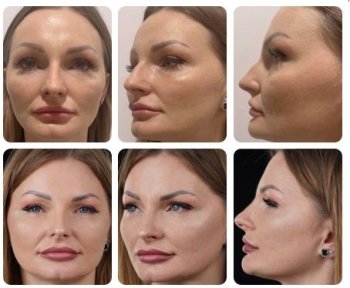 Before and after rhinoplasty results at Yurchenko Plastic Surgery Team, improved nose shape