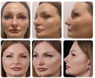 Before and after rhinoplasty results at Yurchenko Plastic Surgery Team, improved nose shape