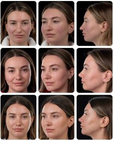 Before and after rhinoplasty results at Yurchenko Plastic Surgery Team, improved nose shape